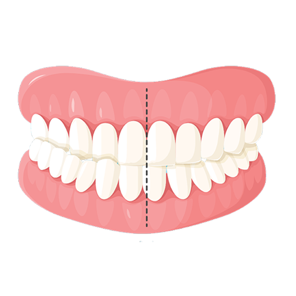 crossbite illustration