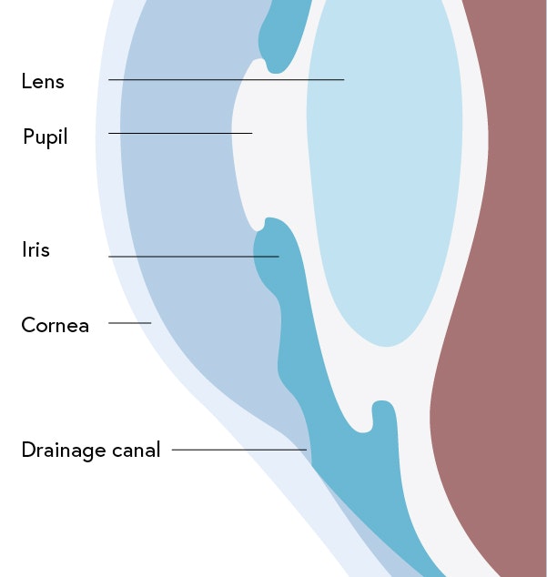 Illustration of Normal Tension Glaucoma with the eye's lens, pupil, iris, cornea, and drainage canal labeled