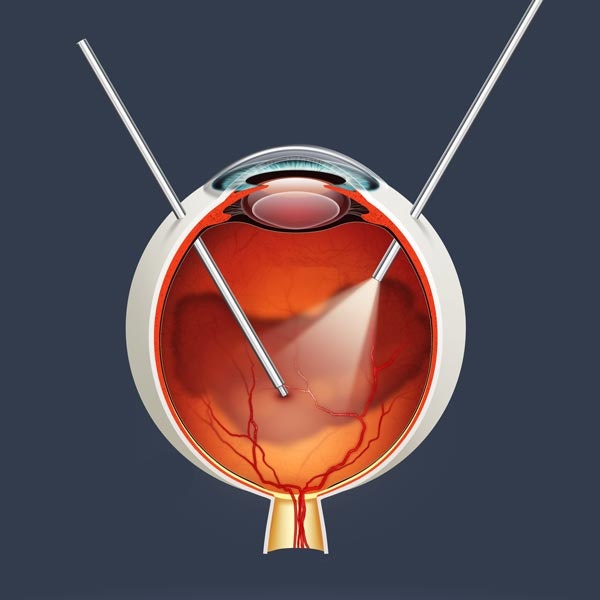 Illustration of Vitrectomy