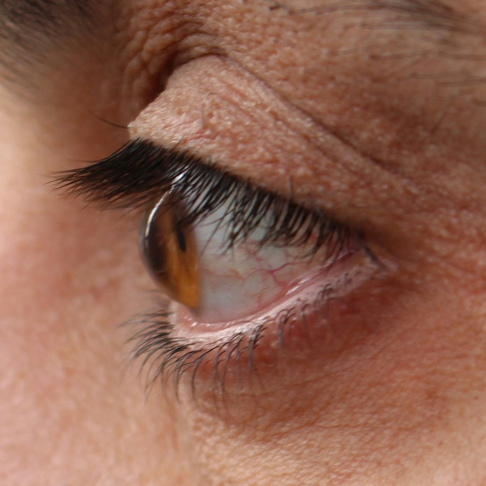 Person's eye with Keratoconus