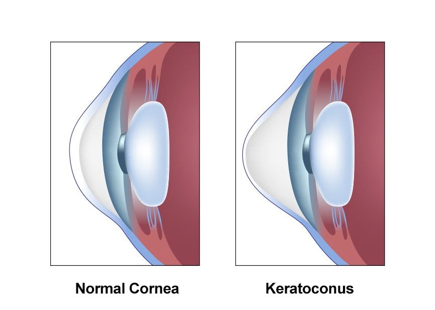 Normal Cornea vs Cornea with Keratoconus