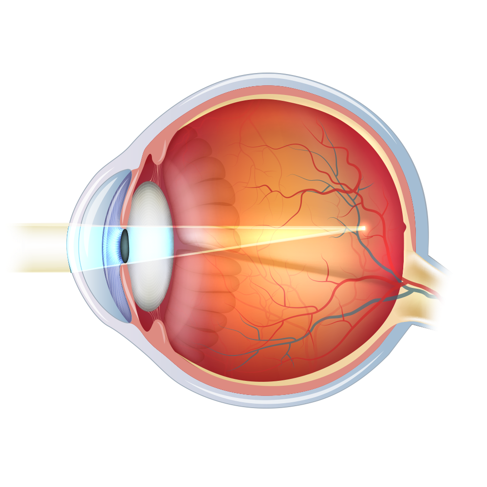 Diagram of myopic eye