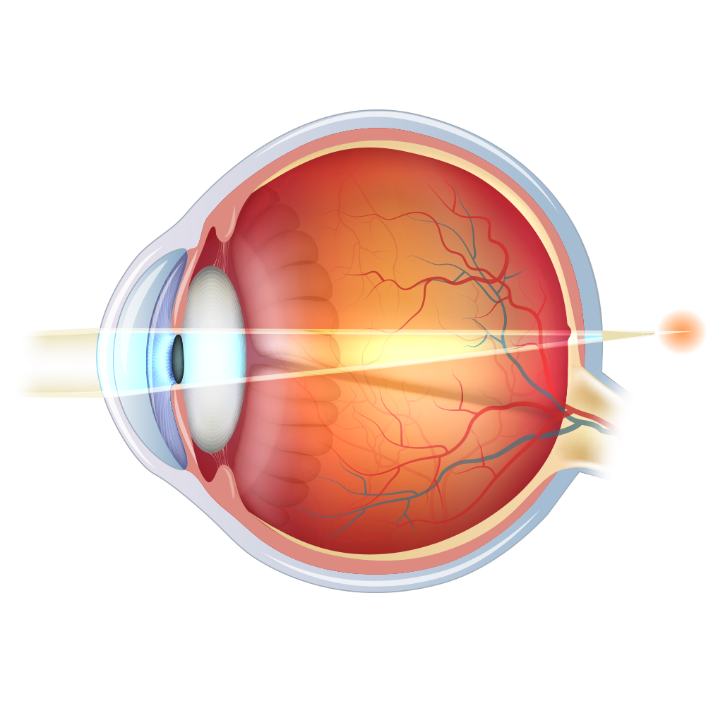 Diagram of hyperopic eye