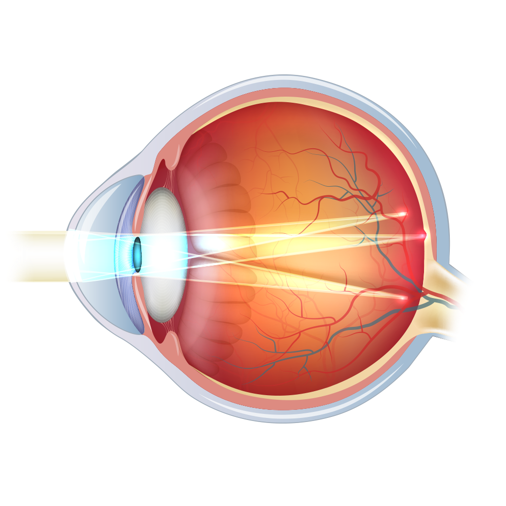 Diagram of astigmatic eye