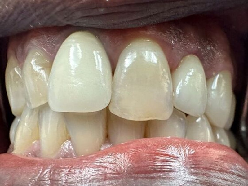 A new crown was placed that looks indistinguishable from the patient's surrounding teeth