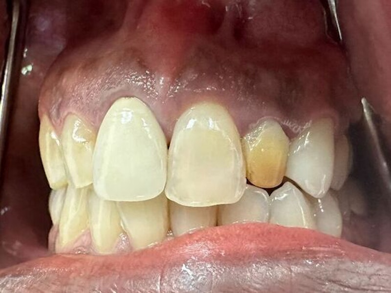 Patient with infected, yellow tooth