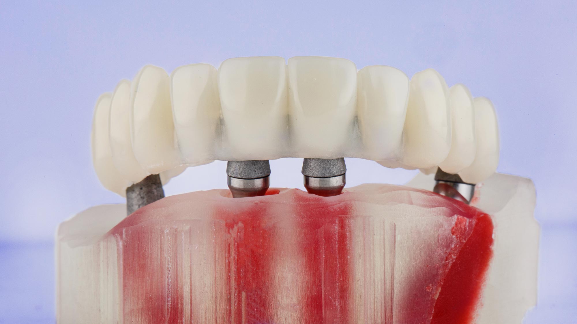 All-on-4 denture