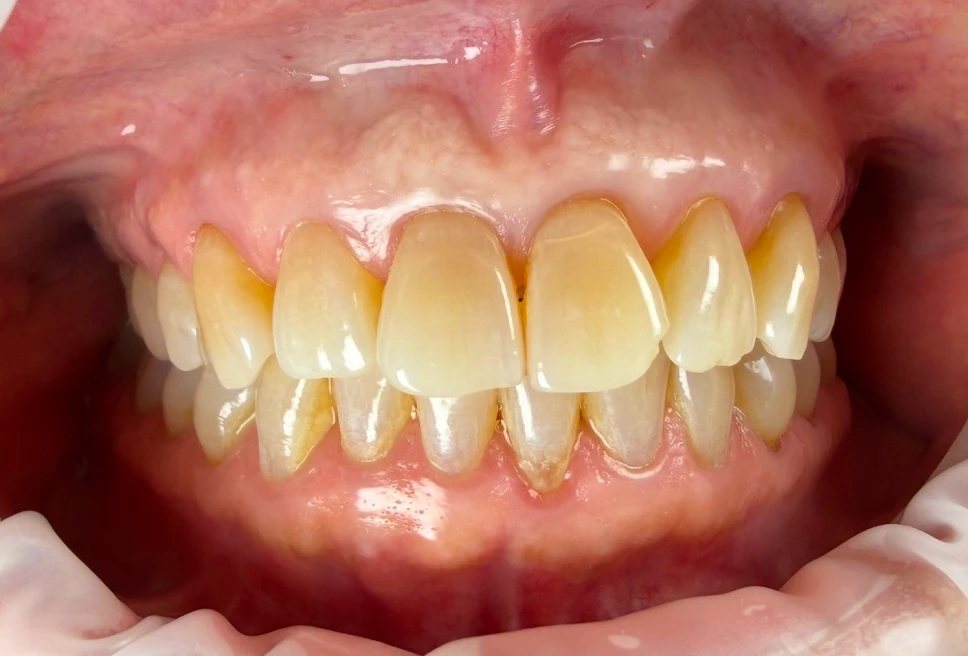 Discolored front tooth before treatment