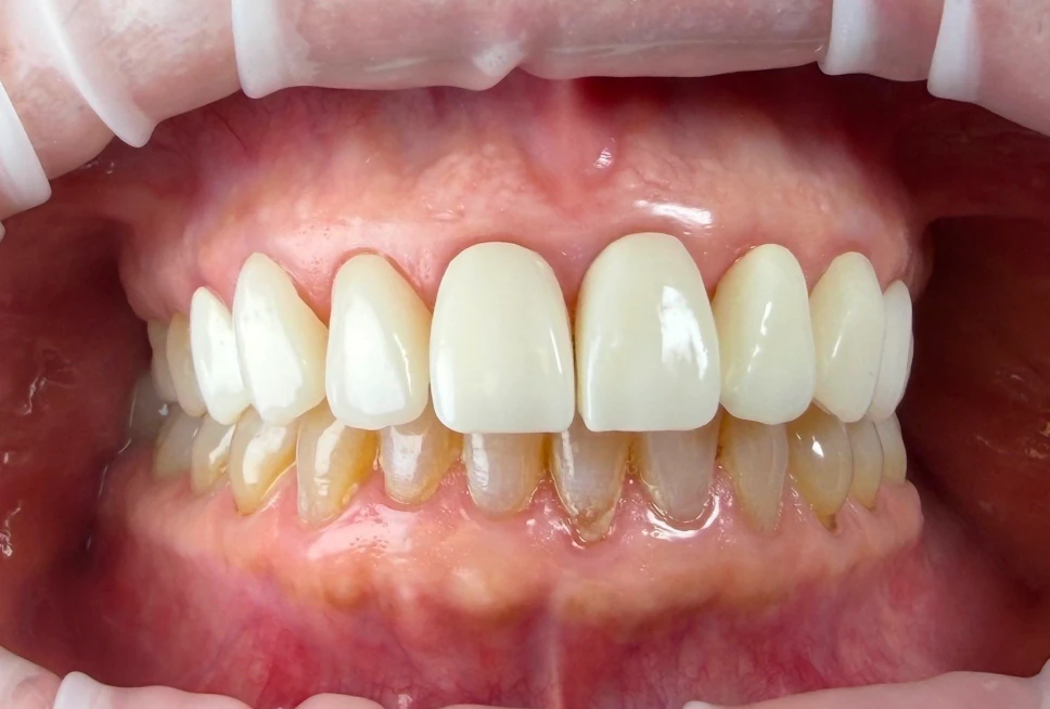 Front teeth after a lifelike dental crown