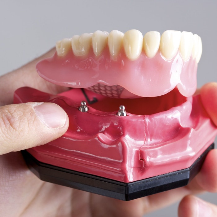 All-on-4 dental implants, denture, and model of lower jaw