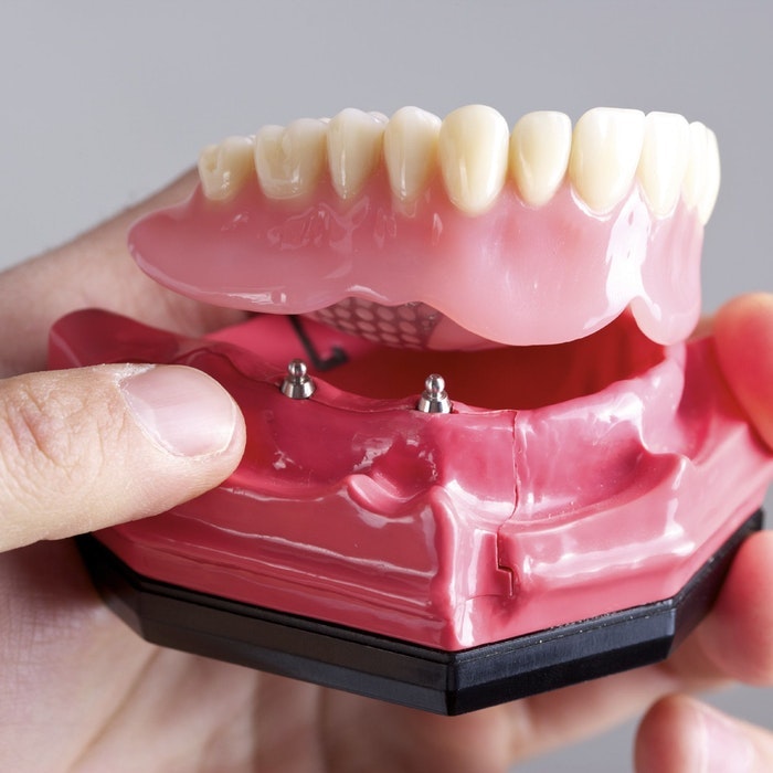 All-on-4 dental implants, denture, and model of lower jaw