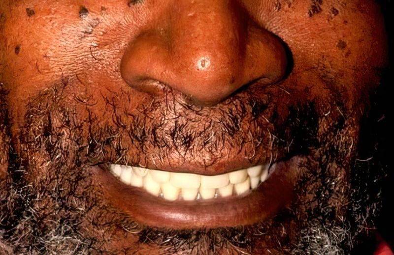 Dr. Steven L Ollason's patient after full mouth reconstruction