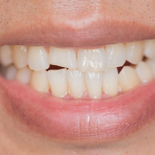 Cracked tooth