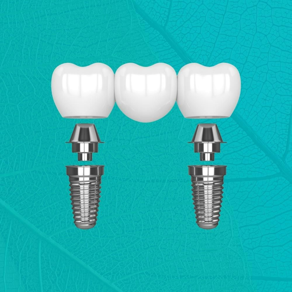 implant-supported bridge