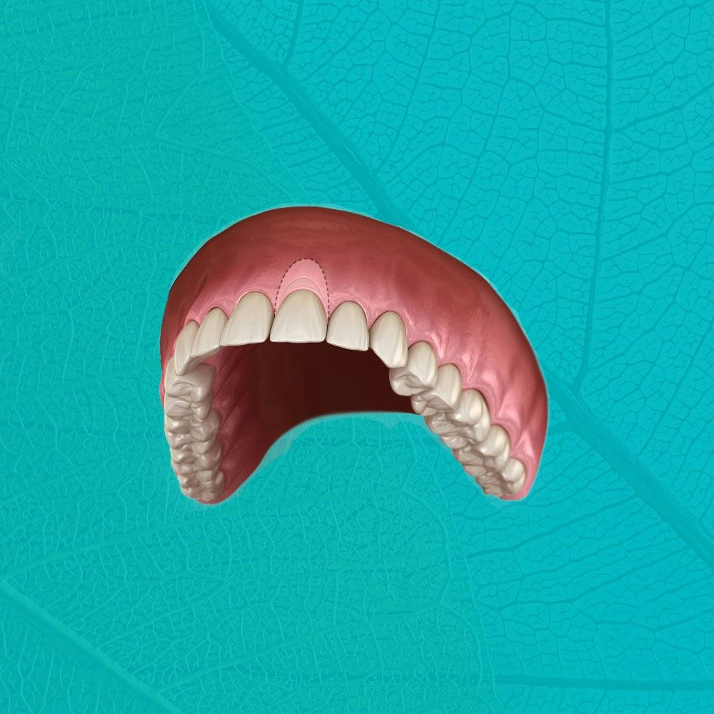 Illustration of before and after gum contouring