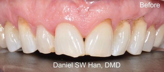 Smile Designer of Leesburg patient with visibly worn and chipped teeth