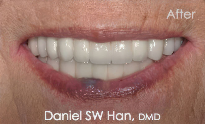 Dr. Daniel Sok Woong Han's patient after full mouth reconstruction