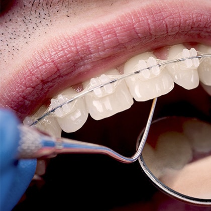 closeup of ceramic braces