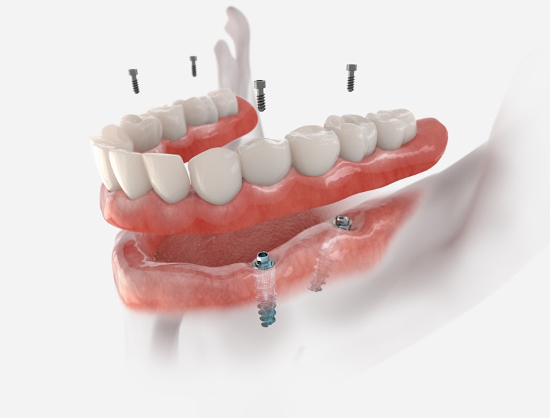 All on 4 Dental Implant illustration
