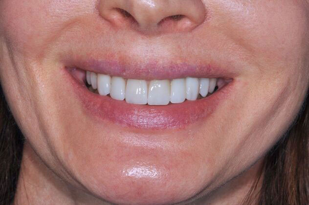 After veneers