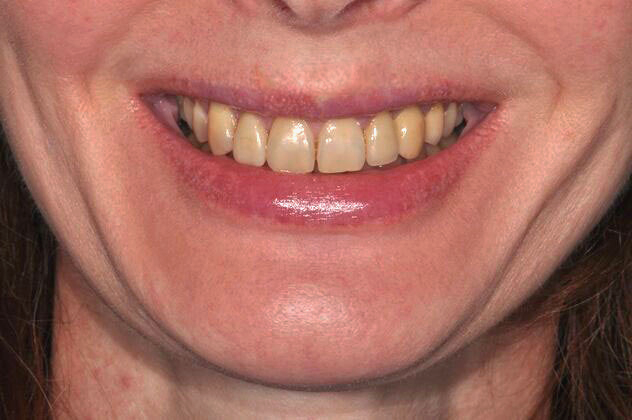 Before veneers