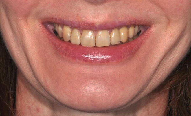 Before veneers