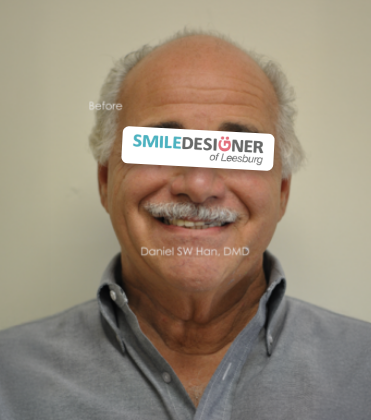 Smile Designer of Leesburg patient before full mouth reconstruction
