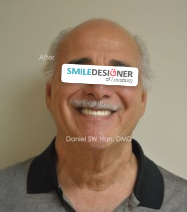 Smile Designer of Leesburg patient after full mouth reconstruction