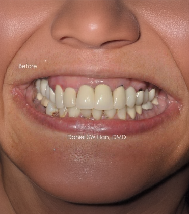 Smile Designer of Leesburg patient before full mouth reconstruction