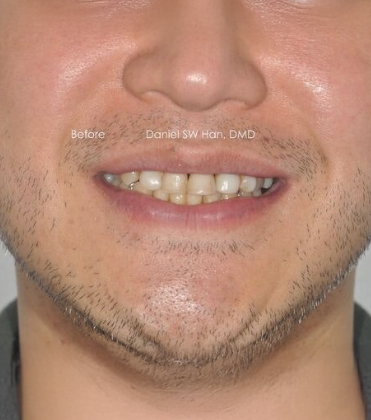 Smile Designer of Leesburg patient before full mouth reconstruction