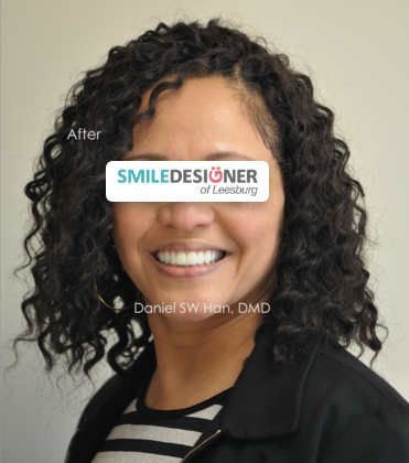 Smile Designer of Leesburg patient after full mouth reconstruction