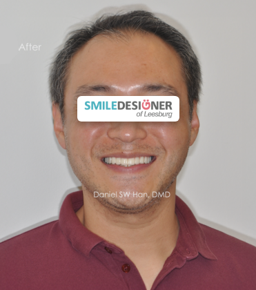 Smile Designer of Leesburg patient after full mouth reconstruction