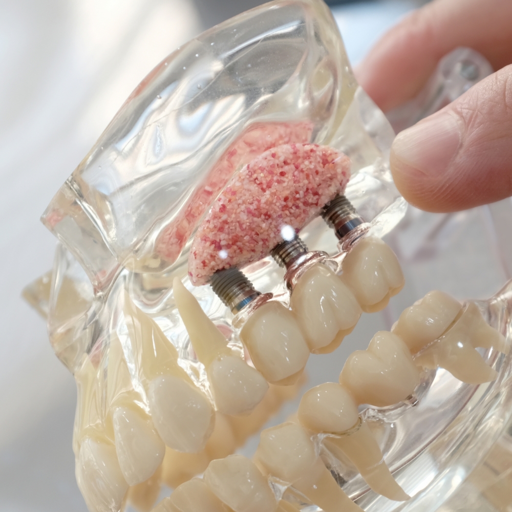 Bone Grafting
