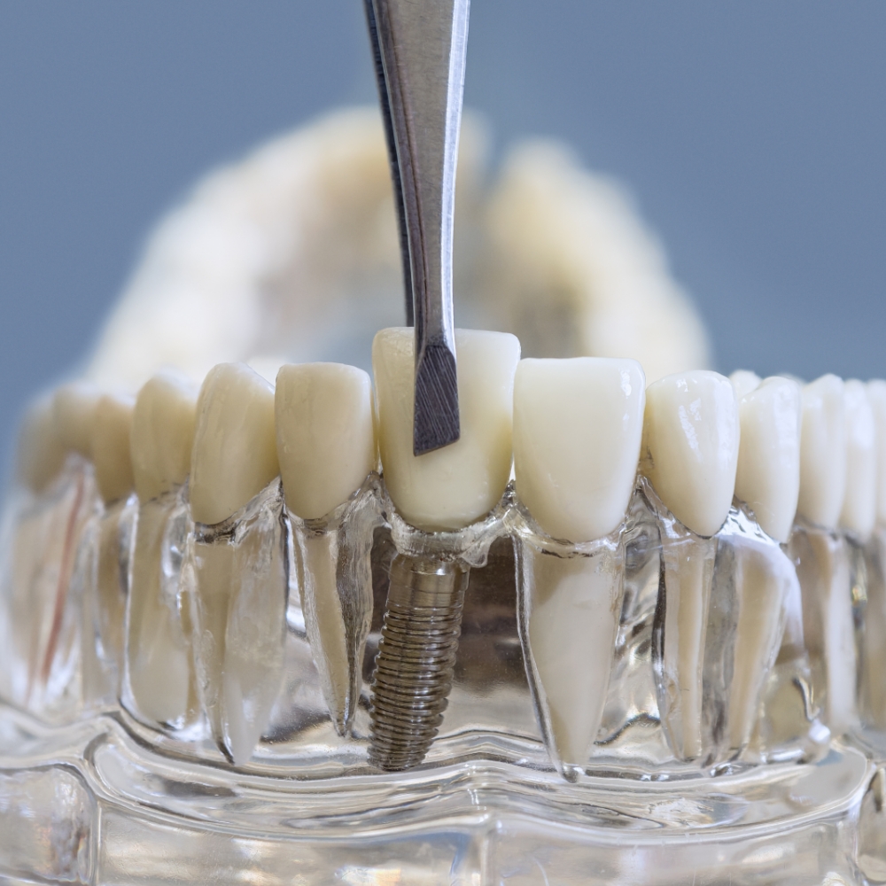 Dental Implants