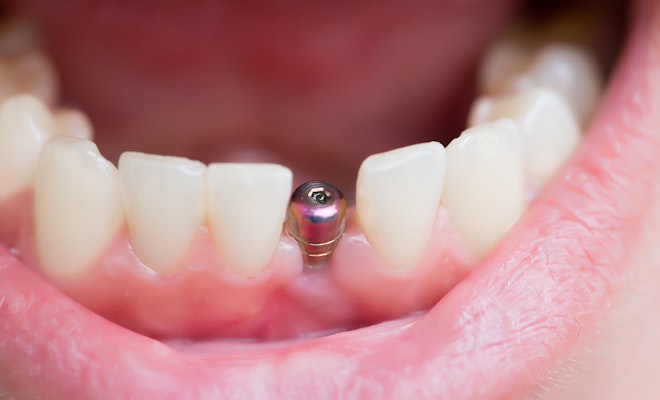 dental implant abutment in mouth