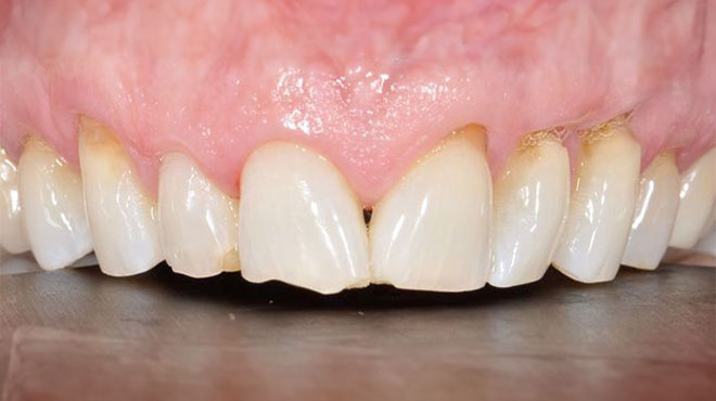 Before cosmetic dentistry treatment