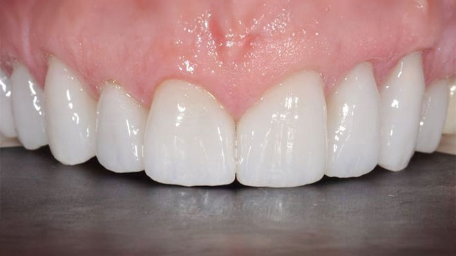 After cosmetic dentistry treatment