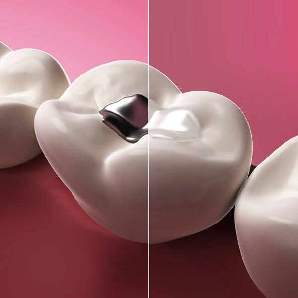 comparison of a metal filling and a resin filling