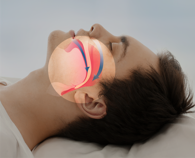 Profile view of sleeping man overlaid with illustration of closed airway