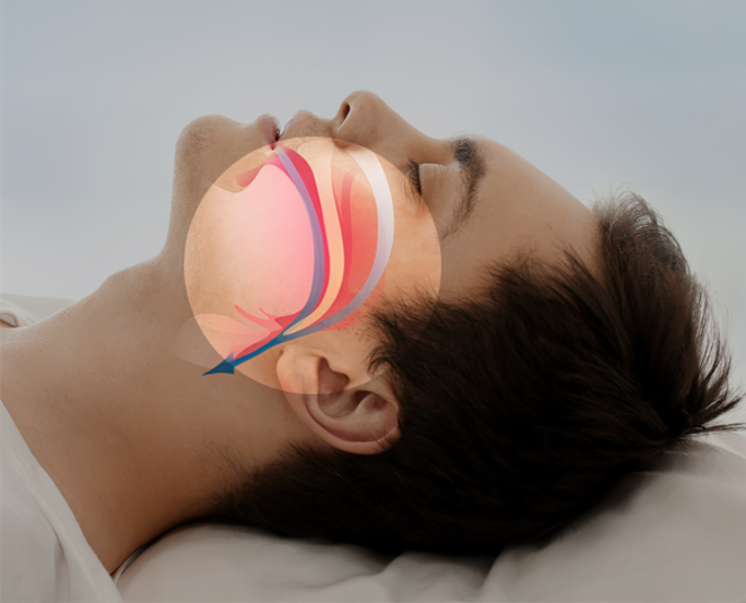 Profile view of sleeping man overlaid with illustration of open airway