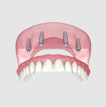 Illustration of all-on-4 implants