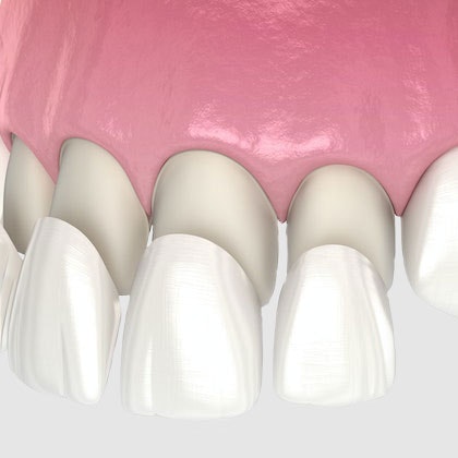Illustration of dental veneers