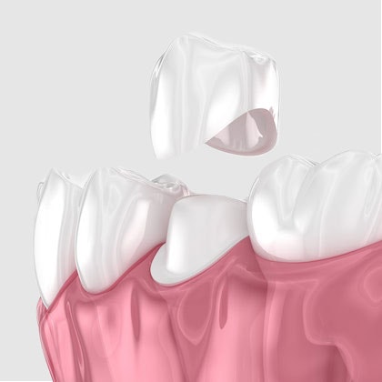 Illustration of a dental crown