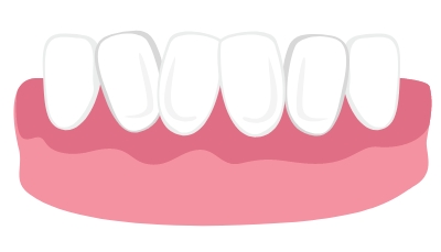 Misaligned Teeth