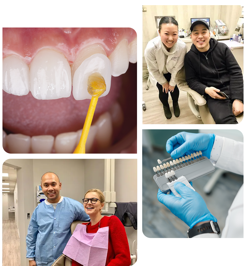 Collage of veneer placement, shade-matching, and happy Murray Hill veneers patients