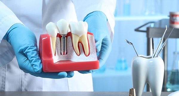 Model of a dental implant in the jaw