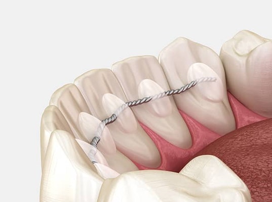 a bonded retainer on bottom row of teeth