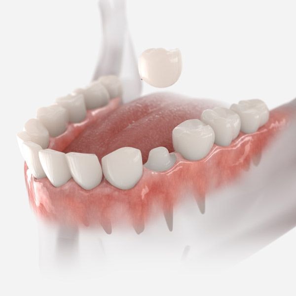 Dental Crowns