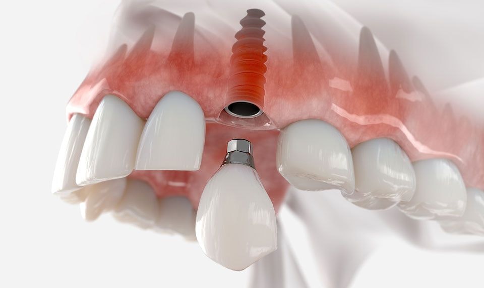 Dental Implants