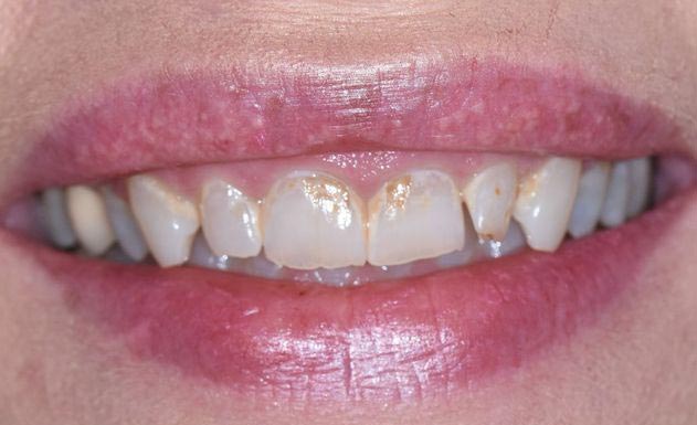 Patient with discolored teeth